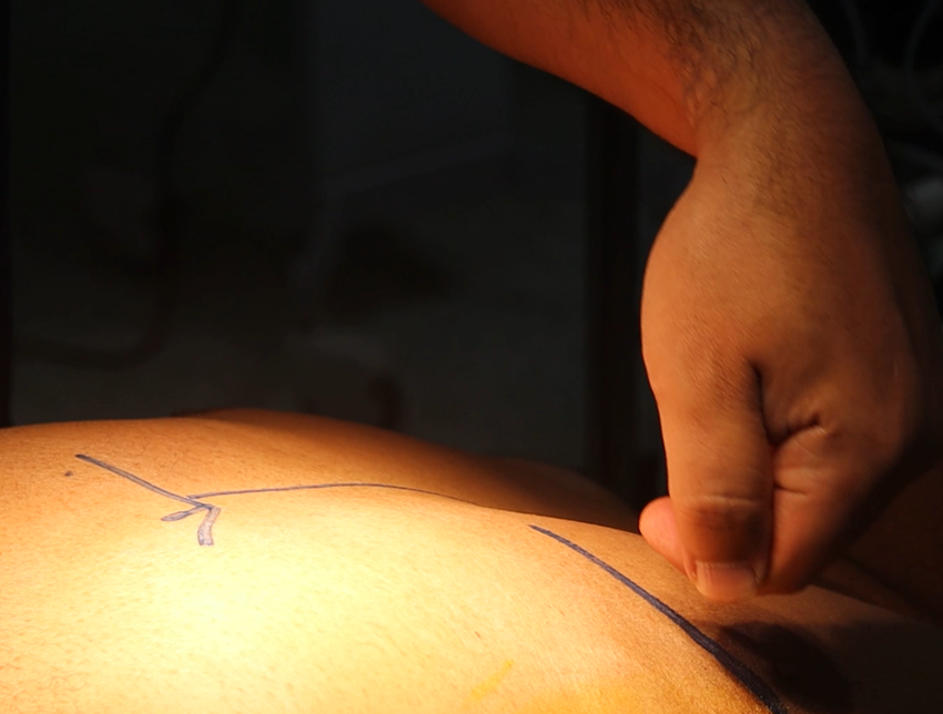 جراحة القلب المفتوح عن طريق التدخل المحدود